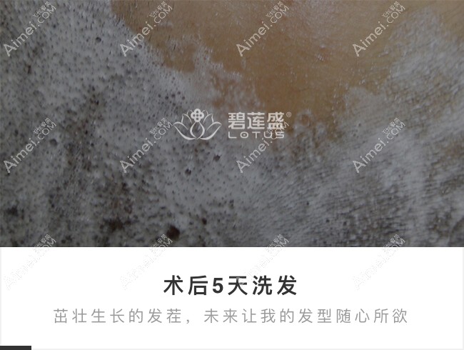 北京碧莲盛前额大面积植发术后第5天洗头.jpg 北京碧莲盛前额大面积植发术后第5天洗头.jpg