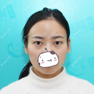 在宜昌蕾帝做全切双眼皮手术前