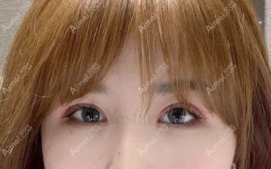 薛提朋医生美杜莎眼综合术后1个月恢复效果.jpg 薛提朋医生美杜莎眼综合术后1个月恢复效果.jpg
