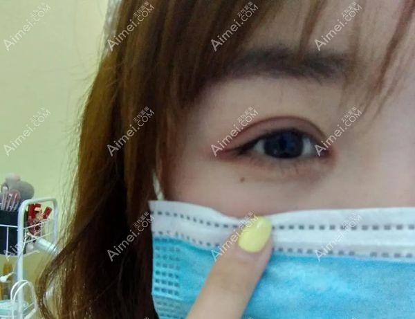 济南艺星美杜莎眼综合术后3天恢复有点红肿.jpg 济南艺星美杜莎眼综合术后3天恢复有点红肿.jpg