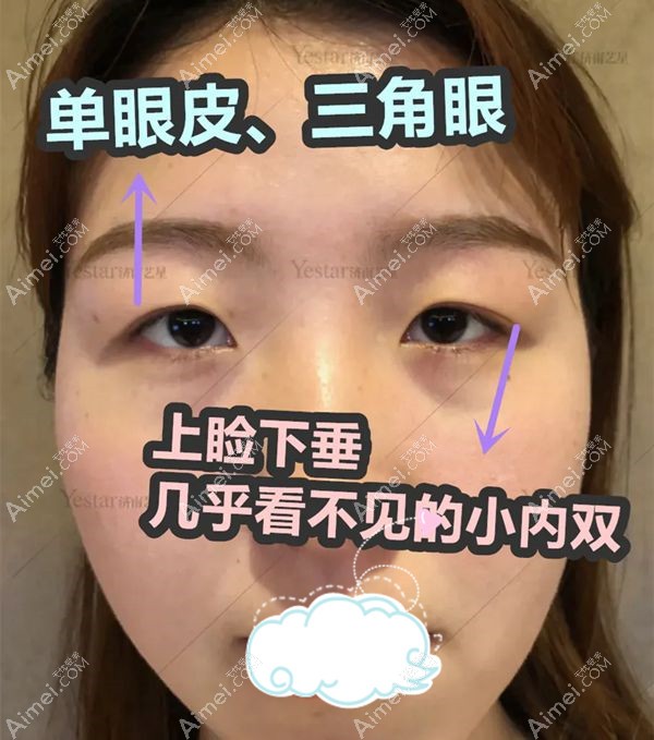 薛提朋医生做美杜莎眼综合案例术前照.jpg 薛提朋医生做美杜莎眼综合案例术前照.jpg