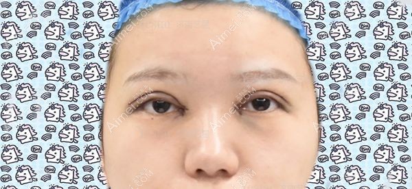 薛提朋医生做的美杜莎小眼综合术后即刻效果.jpg 薛提朋医生做的美杜莎小眼综合术后即刻效果.jpg