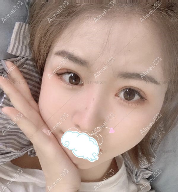 济南艺星美杜莎眼综合术后7天恢复照片.jpg 济南艺星美杜莎眼综合术后7天恢复照片.jpg