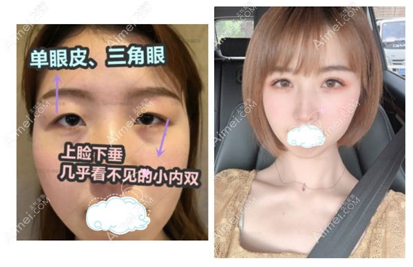 小内双眼睛做完美杜莎眼综合2个月对比效果图.jpg 小内双眼睛做完美杜莎眼综合2个月对比效果图.jpg