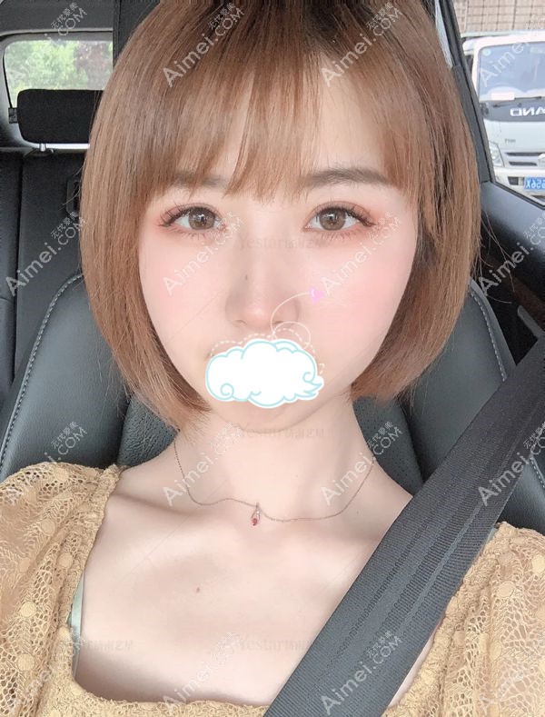 济南艺星美杜莎眼综合术后1个月没有红肿,恢复良好.jpg 济南艺星美杜莎眼综合术后1个月没有红肿,恢复良好.jpg