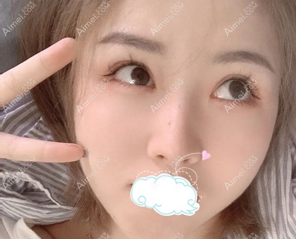 济南艺星美杜莎小眼综合术后7天拆线后效果.jpg 济南艺星美杜莎小眼综合术后7天拆线后效果.jpg