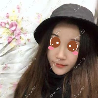 在武汉华美做颧骨下颌角术后一个月 在武汉华美做颧骨下颌角术后一个月