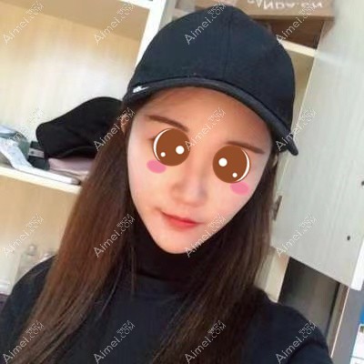 在武汉华美做颧骨下颌角术后15天 在武汉华美做颧骨下颌角术后15天