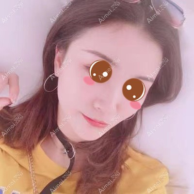 在武汉华美做颧骨下颌角术后6个月 在武汉华美做颧骨下颌角术后6个月