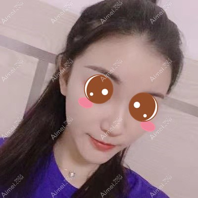 在武汉华美做颧骨下颌角术后3个月 在武汉华美做颧骨下颌角术后3个月