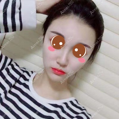 在武汉华美做颧骨下颌角术后一年效果 在武汉华美做颧骨下颌角术后一年效果