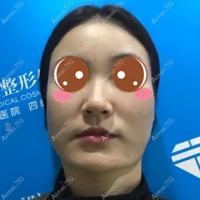 在武汉华美做颧骨下颌角术前 在武汉华美做颧骨下颌角术前