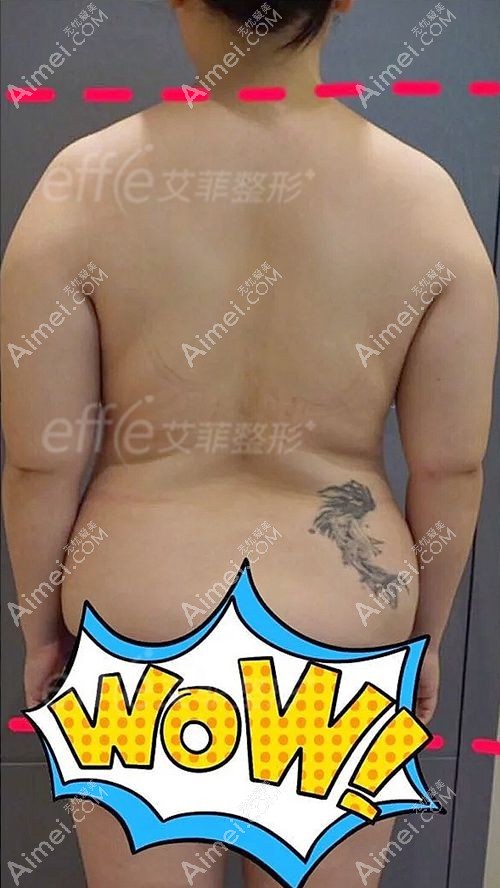 青岛艾菲腰腹吸脂术前照片.jpg 青岛艾菲腰腹吸脂术前照片.jpg