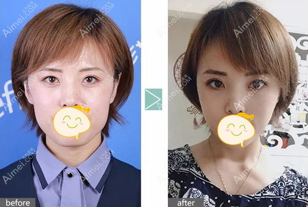 30多岁顾客找郗敏院长做全脸脂肪填充案例图.jpg 30多岁顾客找郗敏院长做全脸脂肪填充案例图.jpg