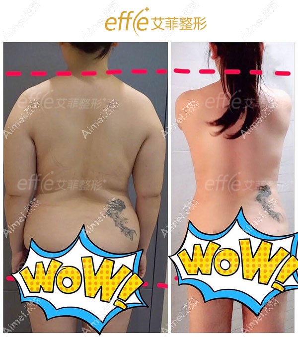 青岛艾菲腰腹环吸手术术前术后对比效果图.jpg 青岛艾菲腰腹环吸手术术前术后对比效果图.jpg
