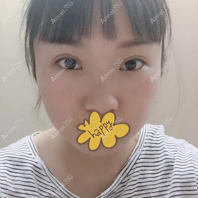 单眼皮美女在泰安韩美做切开双眼皮42天效果图.jpg 单眼皮美女在泰安韩美做切开双眼皮42天效果图.jpg
