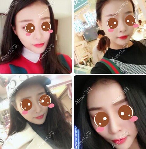 找武汉美基元汪福强做鼻修复术后3个月 找武汉美基元汪福强做鼻修复术后3个月