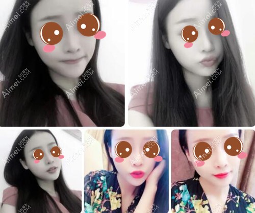 找武汉美基元汪福强做鼻修复术后1个月 找武汉美基元汪福强做鼻修复术后1个月