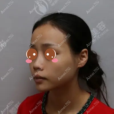 找武汉美基元汪福强做鼻修复术前 找武汉美基元汪福强做鼻修复术前