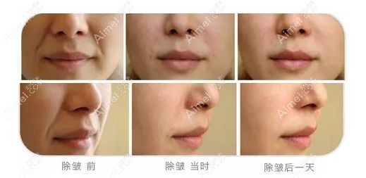王毅超教授注射爱贝芙填充鼻唇沟1天后对比效果.jpg 王毅超教授注射爱贝芙填充鼻唇沟1天后对比效果.jpg