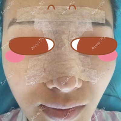 在武汉美莱做耳软骨鼻综合术后5天 在武汉美莱做耳软骨鼻综合术后5天