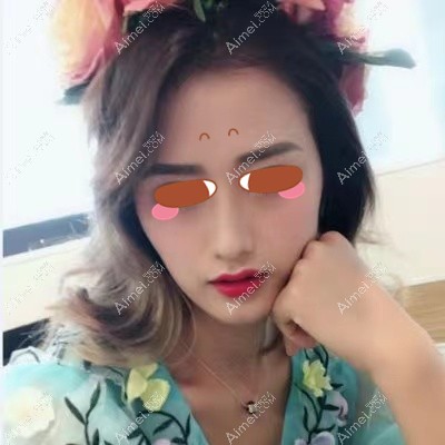 在武汉美莱做耳软骨鼻综合术后3个月 在武汉美莱做耳软骨鼻综合术后3个月