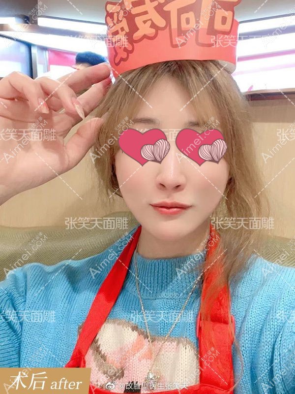 40岁的顾客发颧骨缩小+下颌角削骨手术5年后案例图.jpg 40岁的顾客发颧骨缩小+下颌角削骨手术5年后案例图.jpg