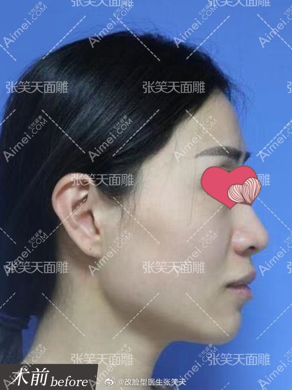 张笑天院长做的颧骨缩小+下颌角削骨手术术前侧面图.jpg 张笑天院长做的颧骨缩小+下颌角削骨手术术前侧面图.jpg