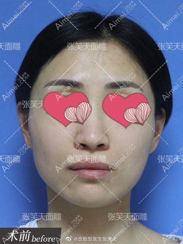 张笑天院长做的颧骨缩小+下颌角削骨手术术前正面图.jpg 张笑天院长做的颧骨缩小+下颌角削骨手术术前正面图.jpg