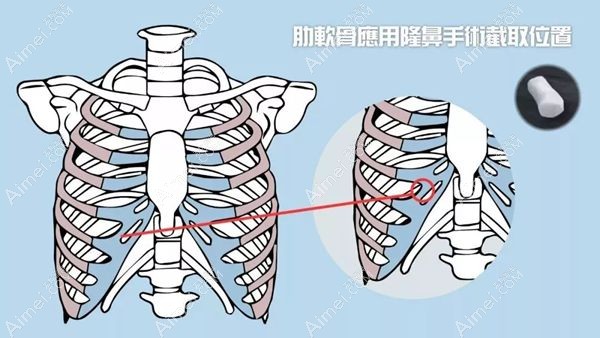 鼻小柱延长选择自体肋软骨.jpg 鼻小柱延长选择自体肋软骨.jpg