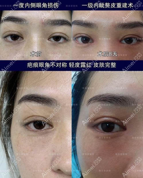 北京丽星翼美魏志香院长开内眼角修复包眼角手术案例.jpg