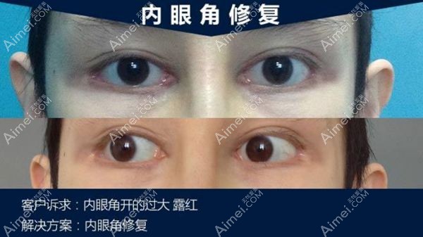 魏志香医生做的内眼角修复手术案例.jpg