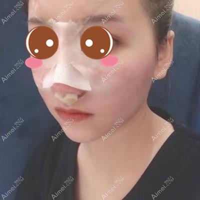 在武汉艺星做鼻综合术后4天