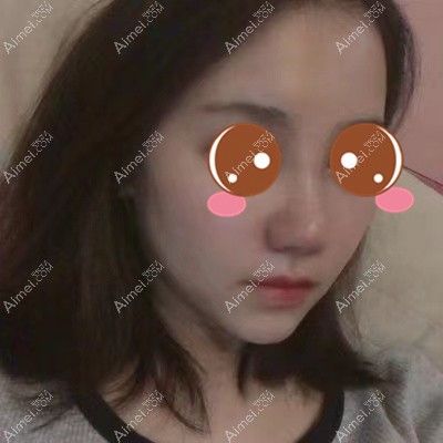 在武汉艺星做鼻综合术后10天