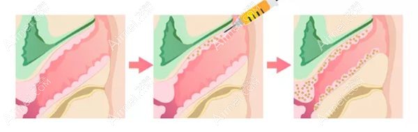 北京壹加壹自体脂肪阴道紧缩的手术过程.jpg 北京壹加壹自体脂肪阴道紧缩的手术过程.jpg