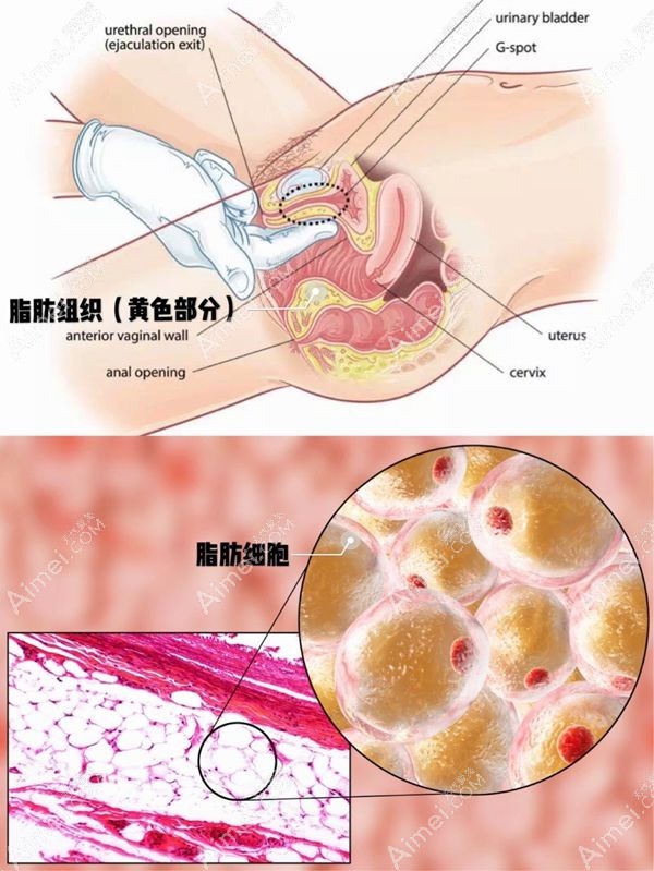 自体脂肪填充至阴道处成活后放大效果.jpg 自体脂肪填充至阴道处成活后放大效果.jpg
