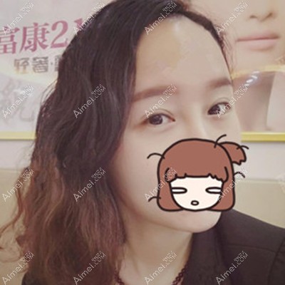 技术真赞!忍不住分享我找武汉富康刘新红院长割双眼皮经历