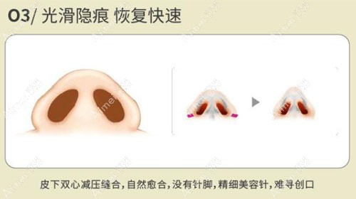 刘冰院长鼻尖塑造真逼真