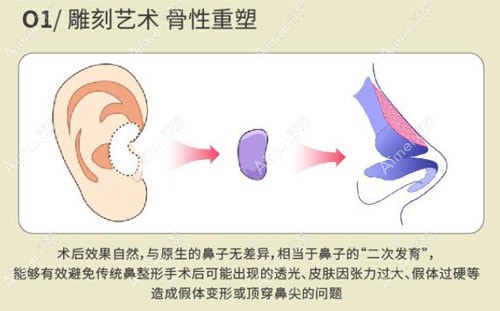 深圳鹏程刘冰耳软骨垫鼻尖优势