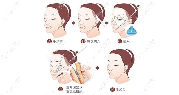 单纯拉皮手术除皱示意图.jpg 单纯拉皮手术除皱示意图.jpg