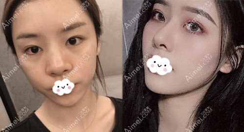 深圳鹏程刘冰自体肋软骨鼻综合案例