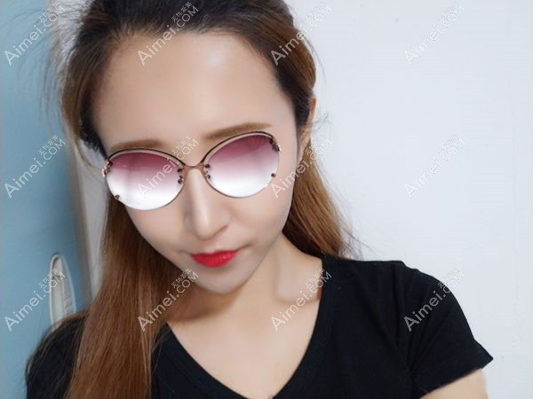 朱金成医生做的自体脂肪填充全脸2个月效果图.jpg 朱金成医生做的自体脂肪填充全脸2个月效果图.jpg