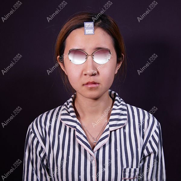 朱金成做自体脂肪填充全脸术前正面照.jpg 朱金成做自体脂肪填充全脸术前正面照.jpg