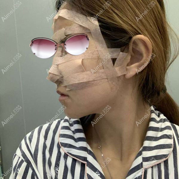 自体脂肪填充全脸第1天肿胀高峰期.jpg 自体脂肪填充全脸第1天肿胀高峰期.jpg