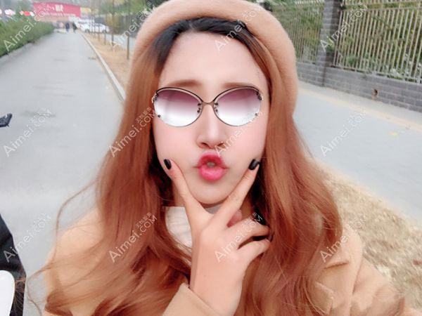 在北京润美玉之光做自体脂肪填充全脸第17天效果图.jpg 在北京润美玉之光做自体脂肪填充全脸第17天效果图.jpg