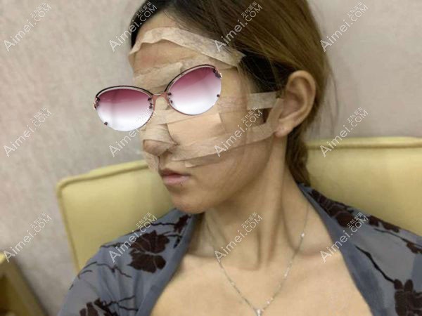 朱金成做的自体脂肪填充第5天肿胀消退不少.jpg 朱金成做的自体脂肪填充第5天肿胀消退不少.jpg