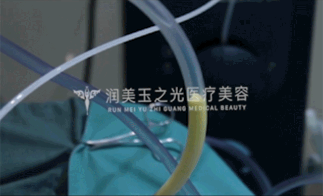 朱金成院长做自体脂肪填充抽脂纯度高.gif 朱金成院长做自体脂肪填充抽脂纯度高.gif