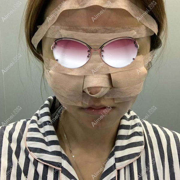 做完自体脂肪填充全脸术后第1天.jpg 做完自体脂肪填充全脸术后第1天.jpg