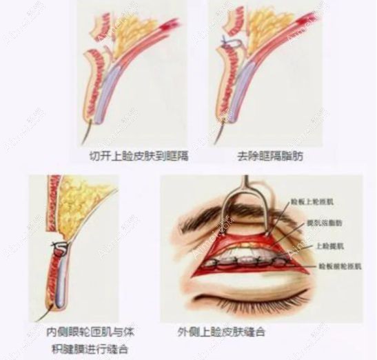 park双眼皮的手术操作流程.jpg