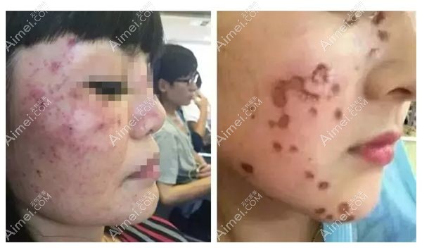 山寨皮秒仪器治疗后毁容.jpg 山寨皮秒仪器治疗后毁容.jpg